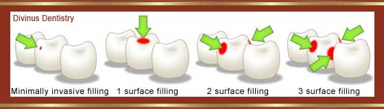 Esztétikus fogtömés