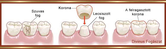 Fogorvos - korona