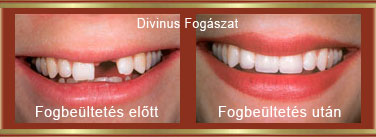Fogbeültetés